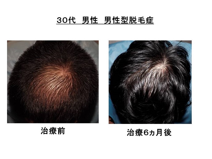 円形脱毛症　名医